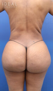 Before Image: BBL Reduction | Correction | Reversal | Awake Surgery