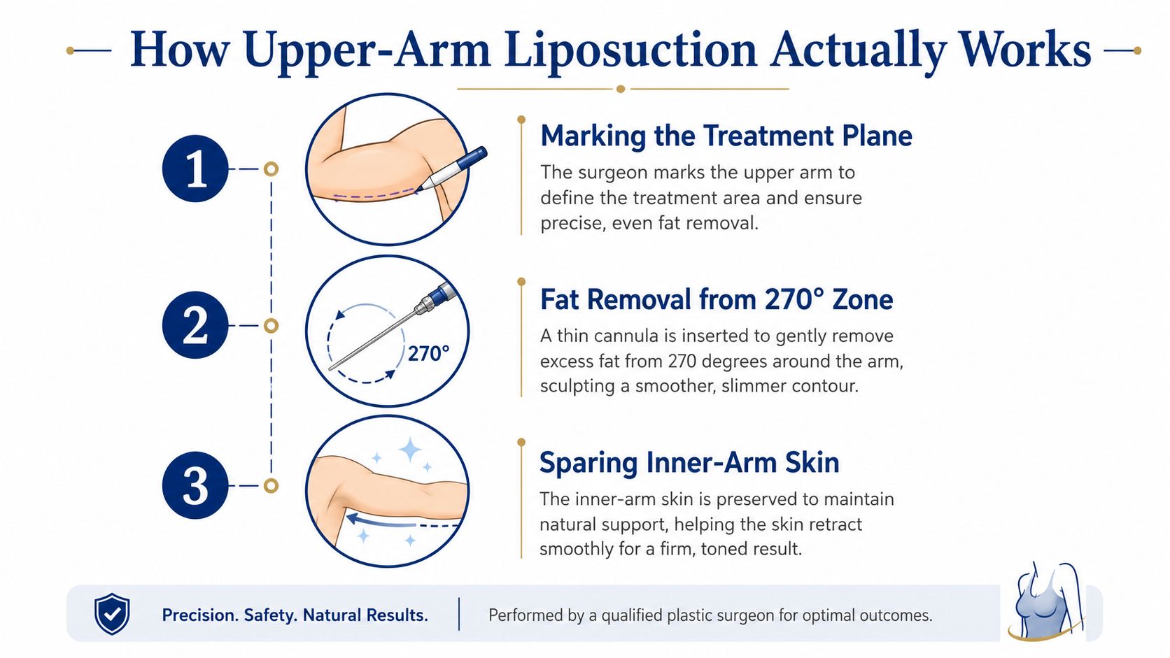 A three-step infographic explaining the procedural process of upper-arm liposuction surgery for body contouring.