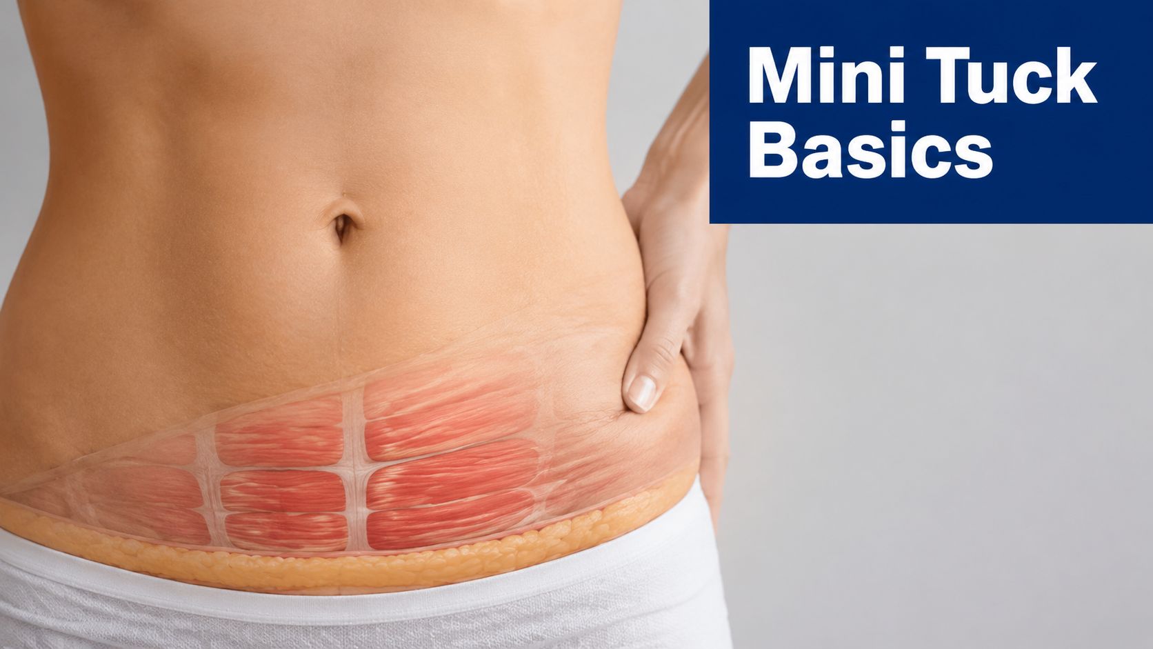 Illustration of a human torso with a visible abdominal muscle layer indicating a mini tummy tuck procedure.