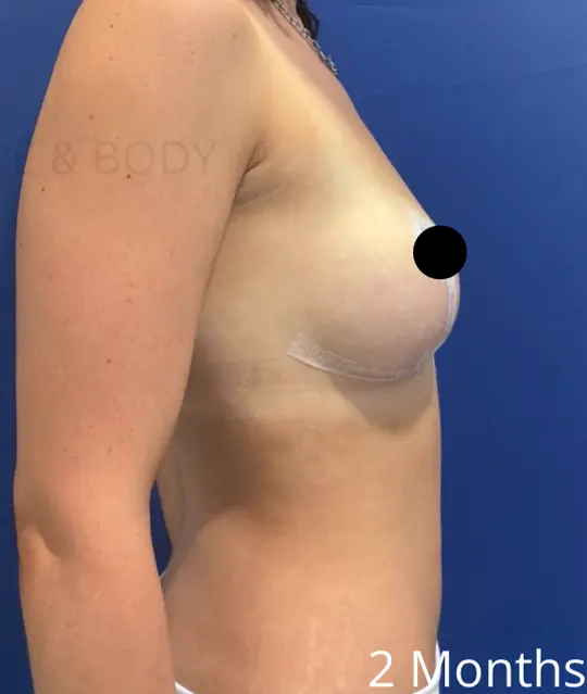 After Image: Awake Breast Reduction | Mammaplasty | Breast Lift - right-side