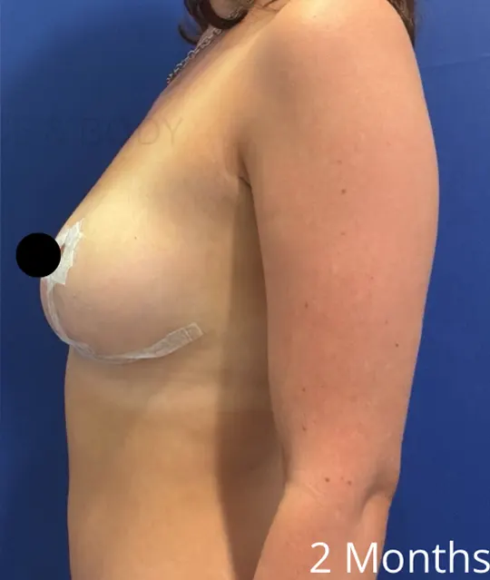 After Image: Awake Breast Reduction | Mammaplasty | Breast Lift - left-side