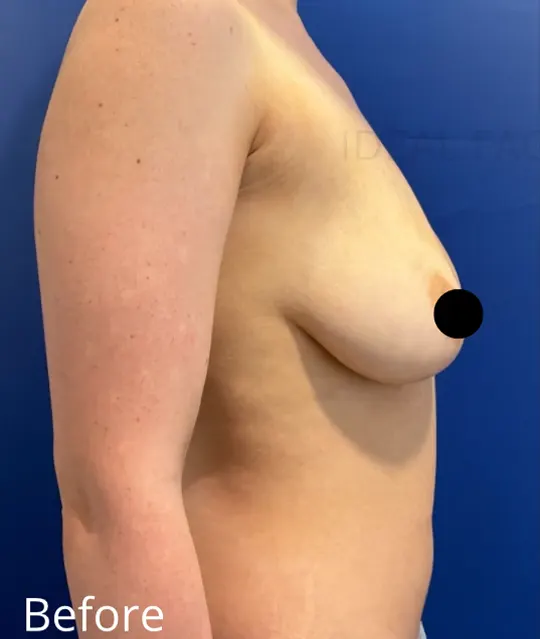Before Image: Awake Breast Reduction | Mammaplasty | Breast Lift - right-side
