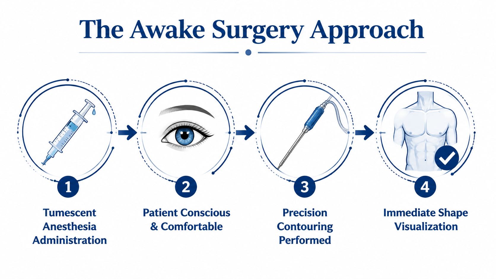 A four-step infographic illustrating the awake surgery approach for male breast reduction with local anesthesia.