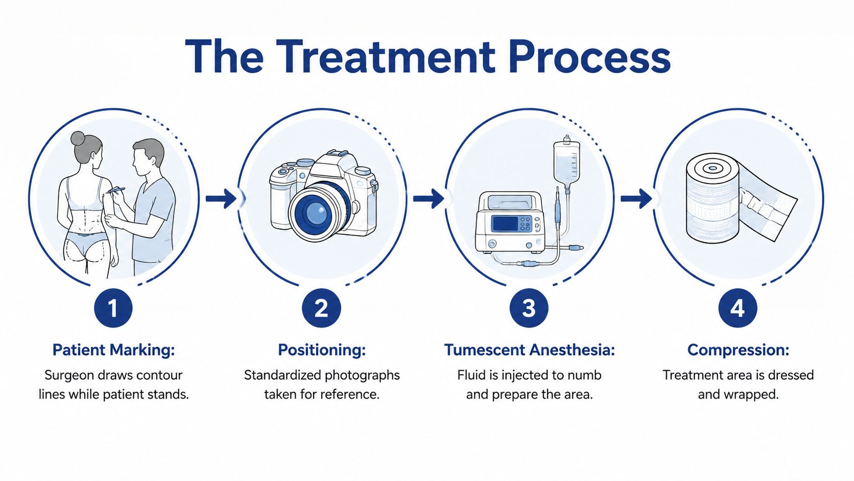 A four-step infographic showing the medical treatment process for liposuction, from patient marking to final compression.