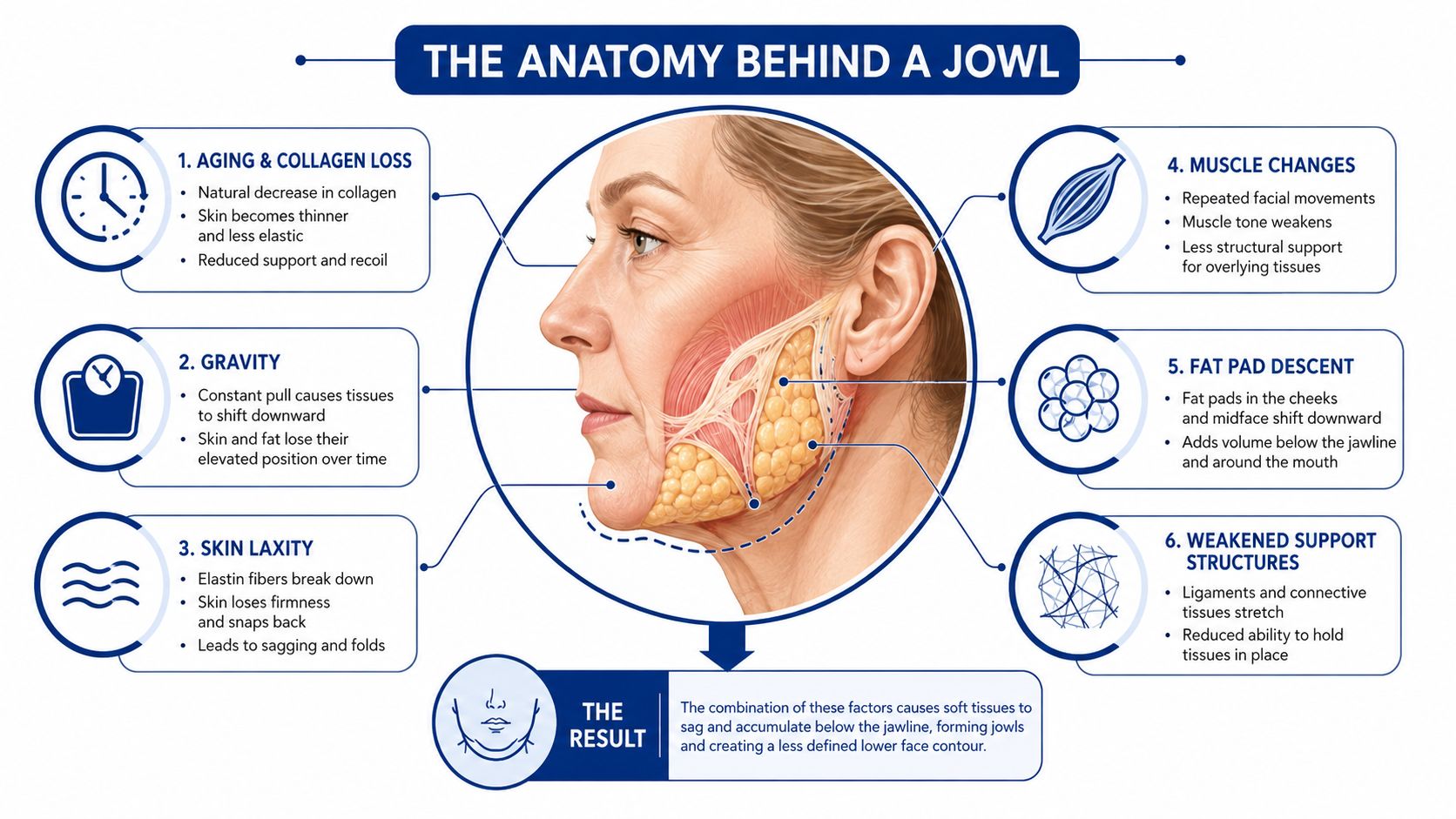 An anatomical illustration showing the six primary causes of jowls, including aging, gravity, and structural tissue changes.