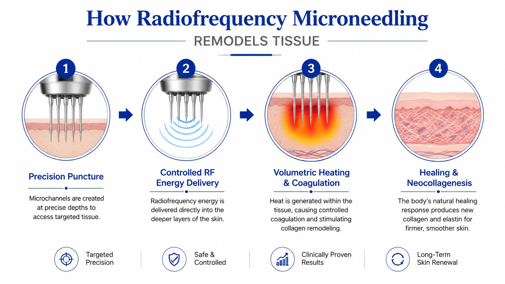 A four-step infographic illustrating how radiofrequency microneedling works to remodel skin tissue for professional treatments.