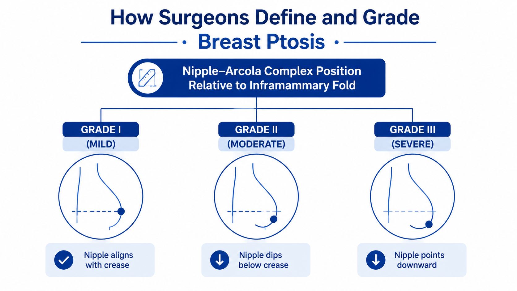 A medical infographic showing the three grades of breast ptosis based on nipple position relative to the fold.