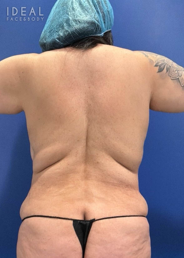 Before Image: Full Back Bra Rolls Liposuction | PRECISION SCULPT® - back