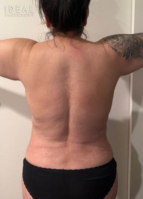 After Image: Full Back Bra Rolls Liposuction | PRECISION SCULPT® - back