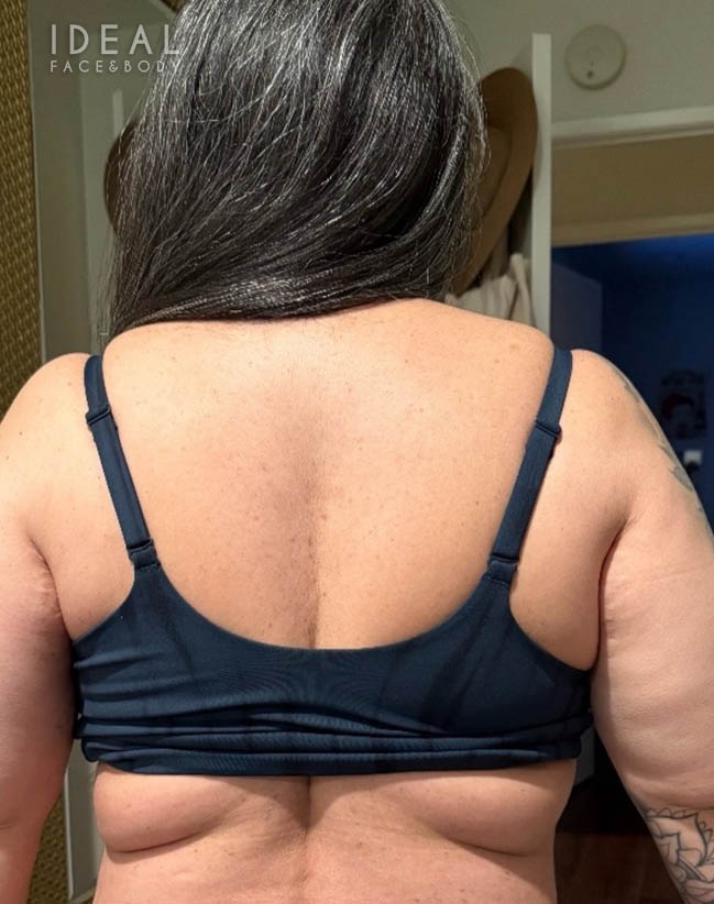 Before Image: Full Back Bra Rolls Liposuction | PRECISION SCULPT® - back
