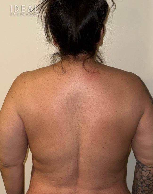 After Image: Full Back Bra Rolls Liposuction | PRECISION SCULPT® - back