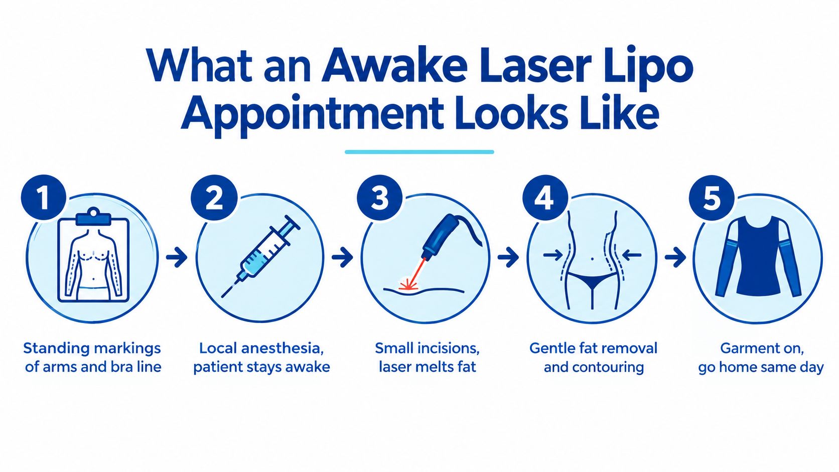 A five-step infographic showing the awake laser lipo procedure process from markings to the final compression garment.