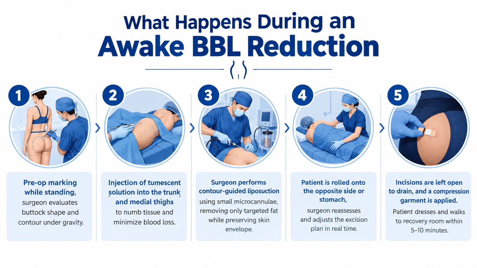 A five-step infographic illustrating the clinical procedure for an awake BBL reduction surgery performed by a surgeon.