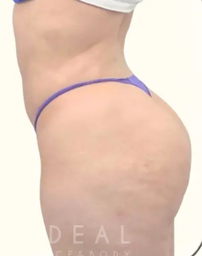 After Image: BBL Reduction | Correction | Reversal | Awake Surgery - left-side