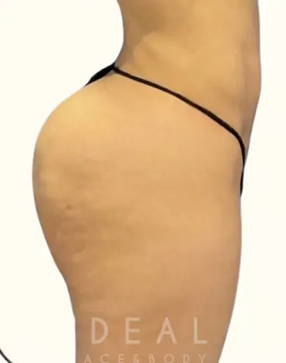 Before Image: BBL Reduction | Correction | Reversal | Awake Surgery - right-side
