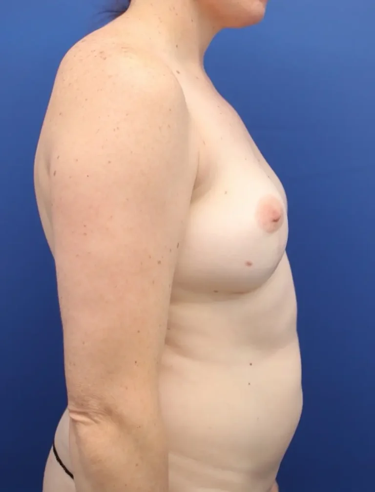 Before Image: Awake Breast Fat Transfer | Raise Your Cup® - right-side