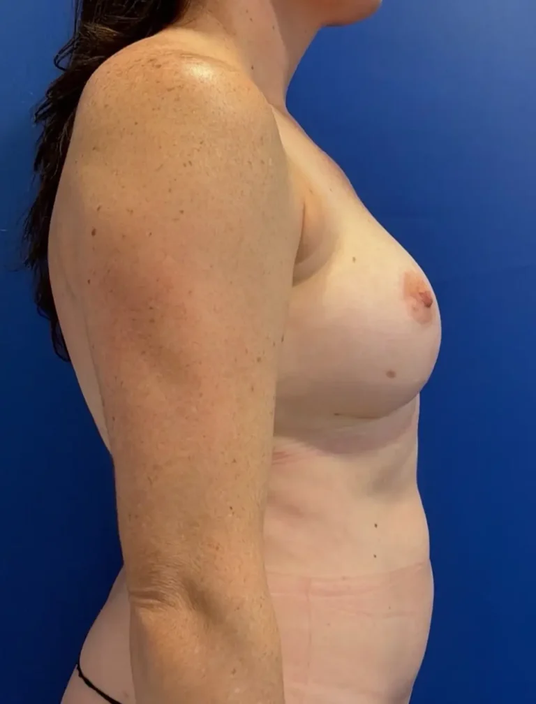 After Image: Awake Breast Fat Transfer | Raise Your Cup® - right-side