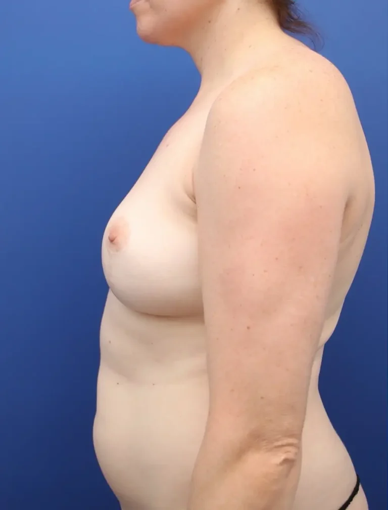 Before Image: Awake Breast Fat Transfer | Raise Your Cup® - 