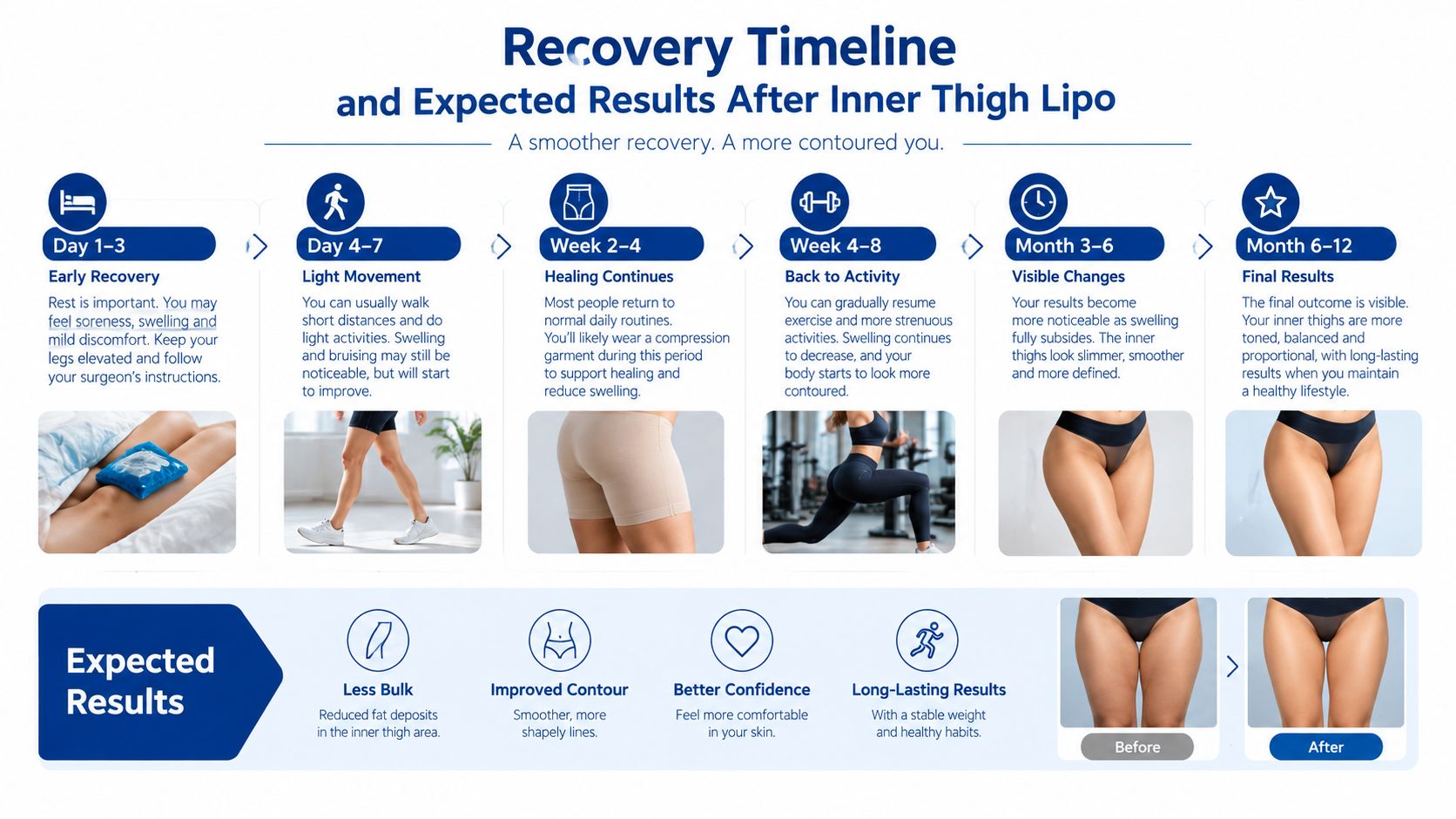 A detailed recovery timeline infographic for inner thigh liposuction surgery showing expected results and post-operative care phases.