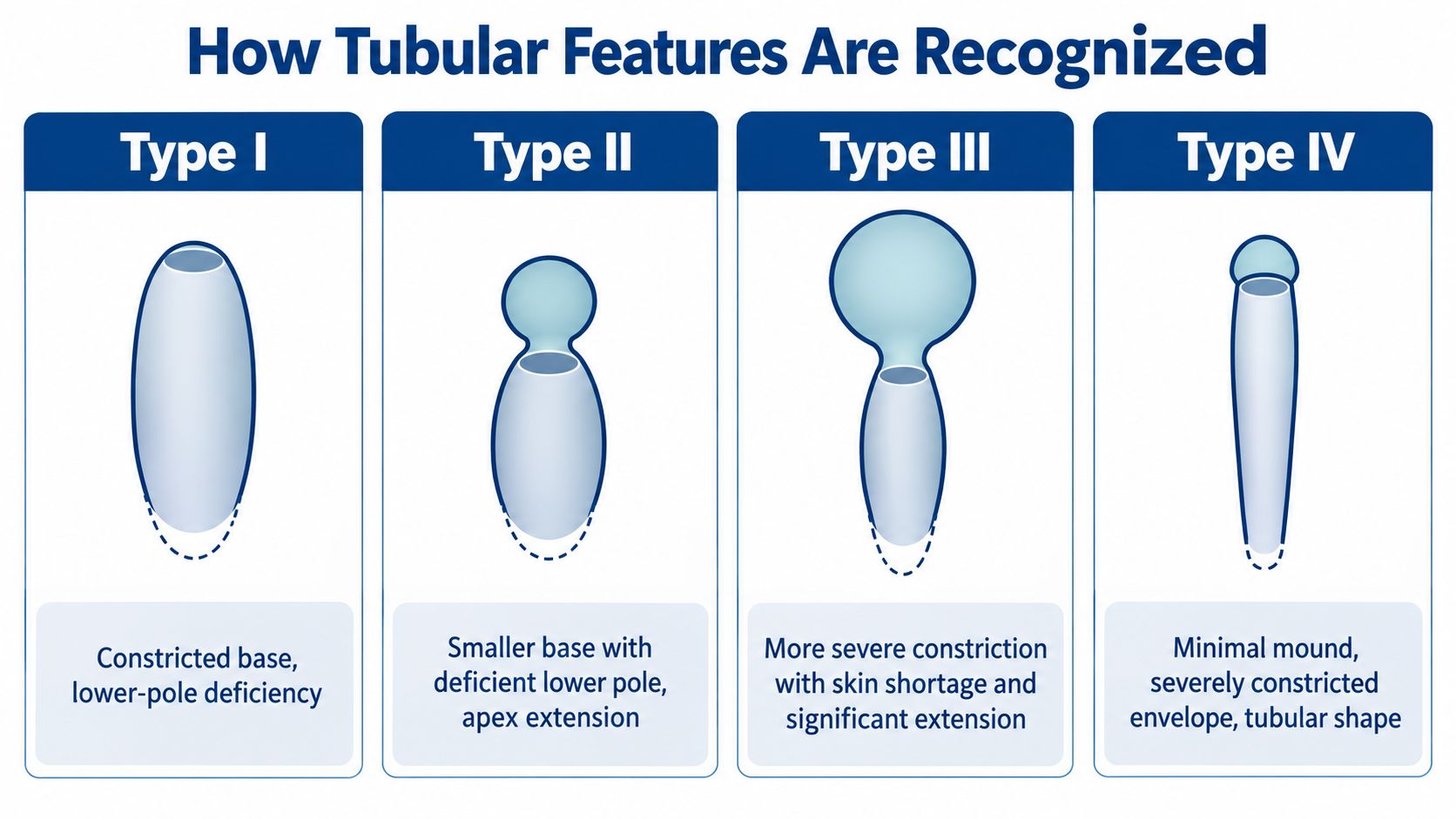 A diagram illustrating the four types of tubular breast deformities characterized by different levels of breast constriction.