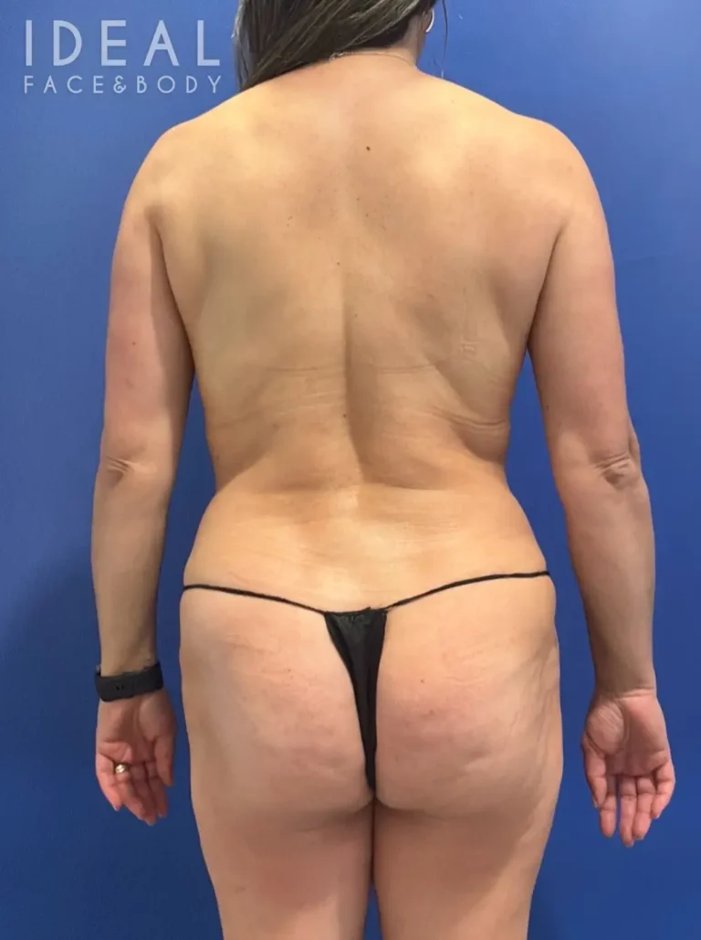 After Image: Awake 360 Liposuction | PRECISION SCULPT® - back