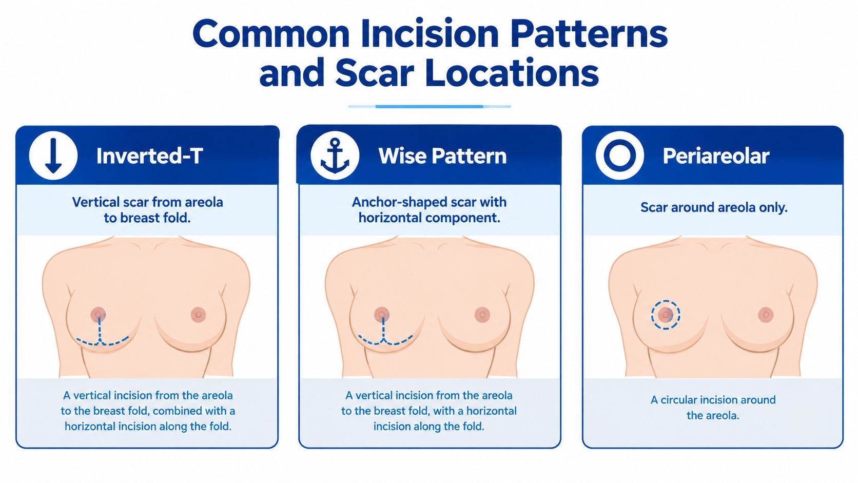 A diagram illustrating common incision patterns and scar locations used during breast reduction surgery procedures.