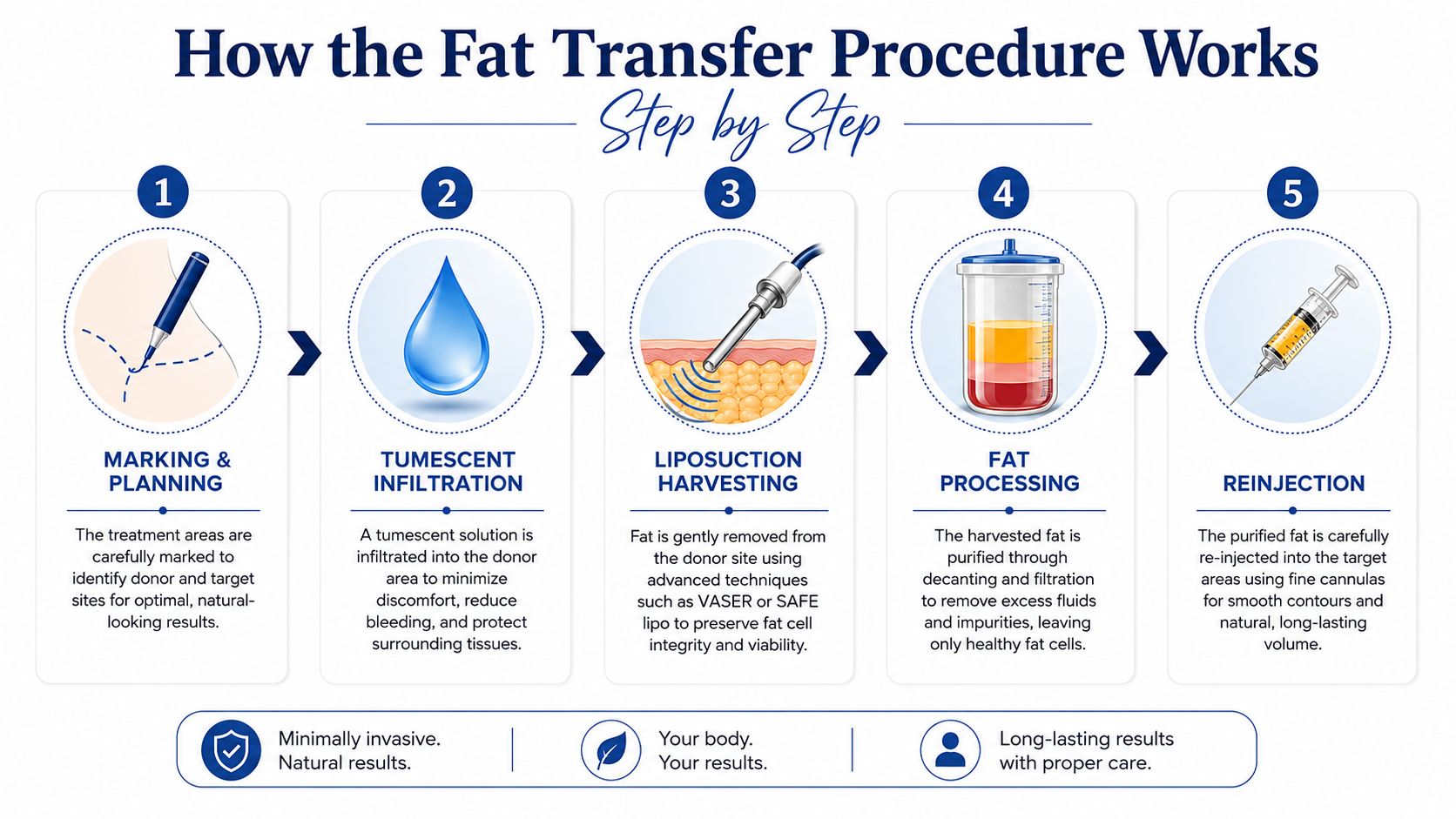A five-step infographic showing the step-by-step fat transfer procedure from marking to final reinjection.