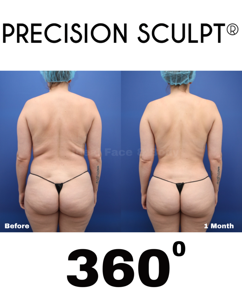 Back Bra Roll Liposuction Beverly Hills