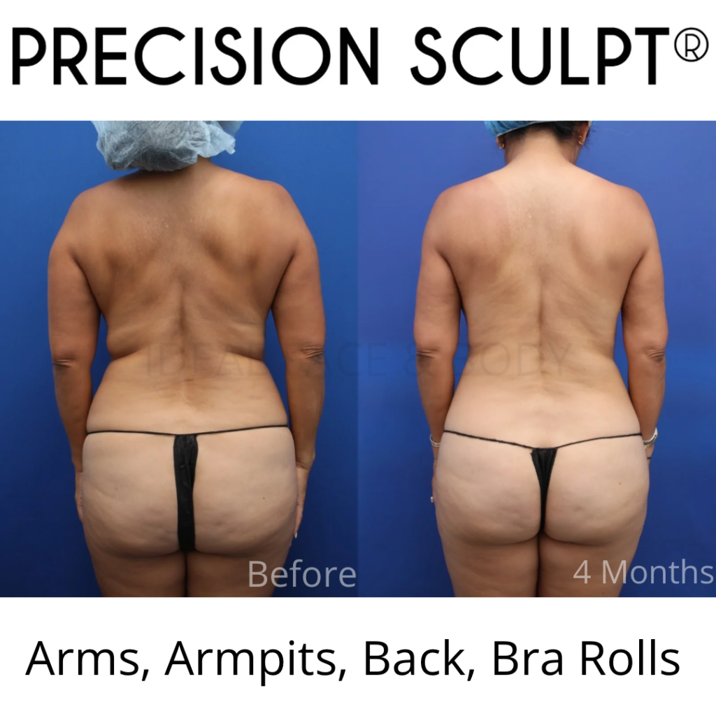 Back Bra Roll Liposuction Beverly Hills