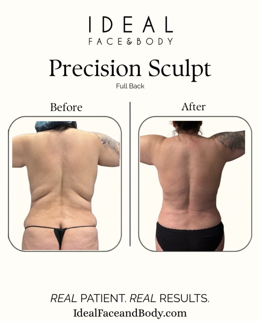 Back Bra Roll Liposuction Beverly Hills