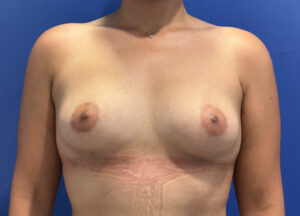After Image: 29 year old female before and 3 months after awake Raise Your Cup®️ Breast Fat Transfer. 280 cc to the left breast and 300 cc to the right breast.