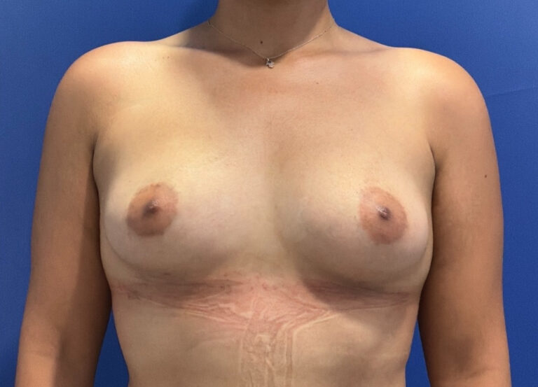 After Image: 29 year old female before and 3 months after awake Raise Your Cup®️ Breast Fat Transfer. 280 cc to the left breast and 300 cc to the right breast. - front