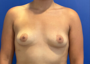 Before Image: 29 year old female before and 3 months after awake Raise Your Cup®️ Breast Fat Transfer. 280 cc to the left breast and 300 cc to the right breast.