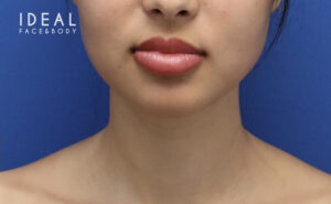After Image: Precision Sculpt® — chin, neck, and jawline