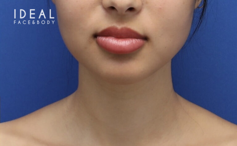 After Image: Precision Sculpt® — chin, neck, and jawline - front