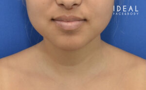 Before Image: Precision Sculpt® — chin, neck, and jawline
