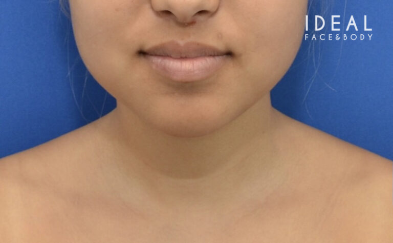 Before Image: Precision Sculpt® — chin, neck, and jawline - front