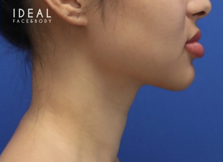 After Image: Precision Sculpt® — chin, neck, and jawline - right-side