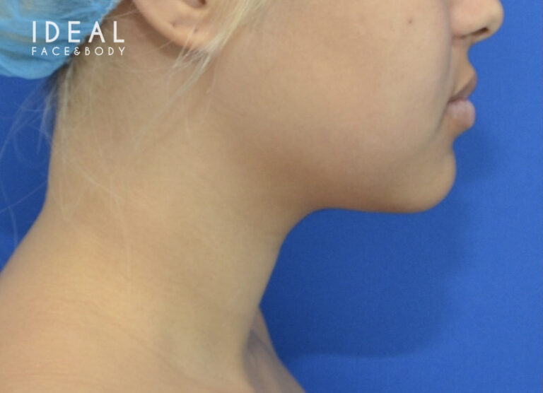 Before Image: Precision Sculpt® — chin, neck, and jawline - right-side