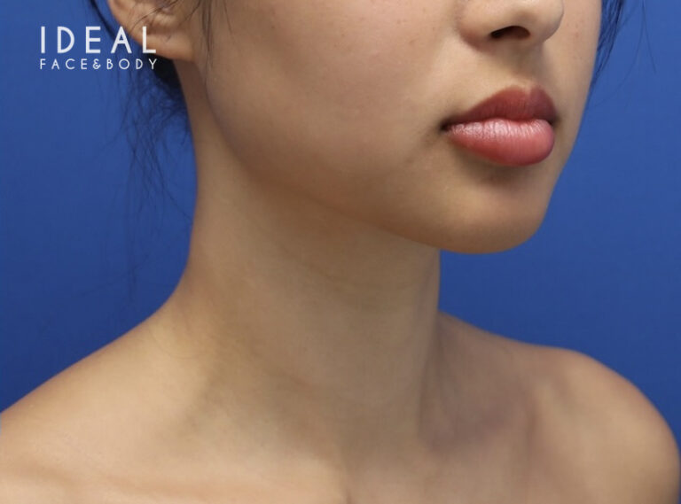After Image: Precision Sculpt® — chin, neck, and jawline - right-front-oblique