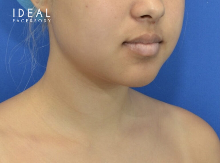 Before Image: Precision Sculpt® — chin, neck, and jawline - right-front-oblique