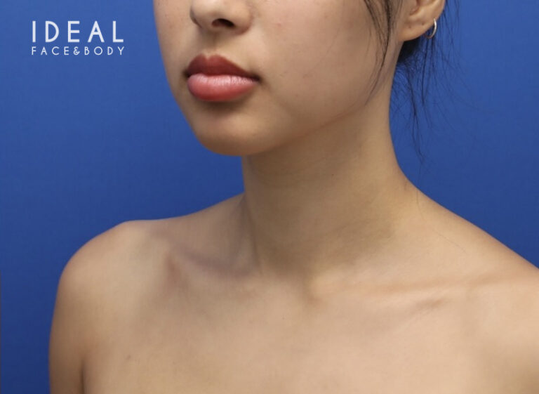 After Image: Precision Sculpt® — chin, neck, and jawline - left-front-oblique
