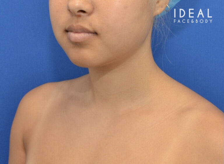 Before Image: Precision Sculpt® — chin, neck, and jawline - left-front-oblique