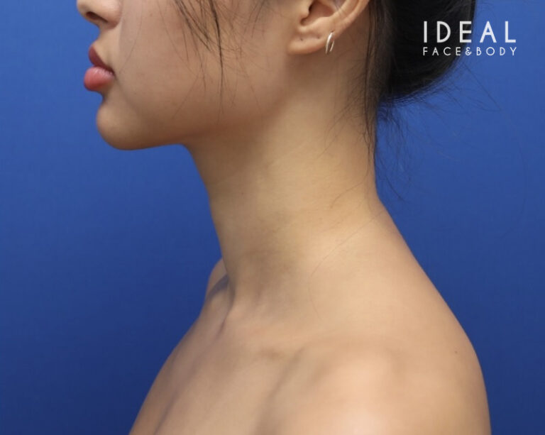 After Image: Precision Sculpt® — chin, neck, and jawline - left-side