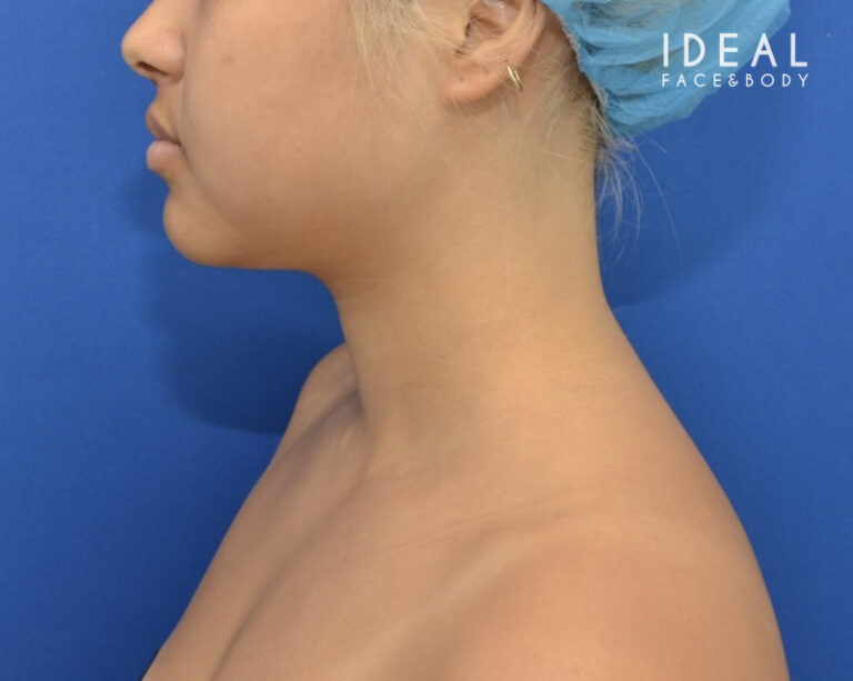 Before Image: Precision Sculpt® — chin, neck, and jawline - left-side
