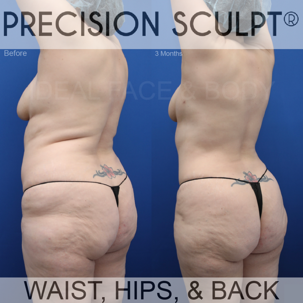 Back Bra Roll Liposuction Beverly Hills