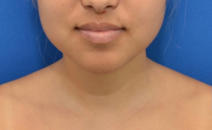 Before Image: Precision Sculpt® — chin, neck, and jawline