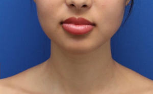 After Image: Precision Sculpt® — chin, neck, and jawline