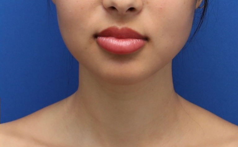 After Image: Precision Sculpt® — chin, neck, and jawline - front