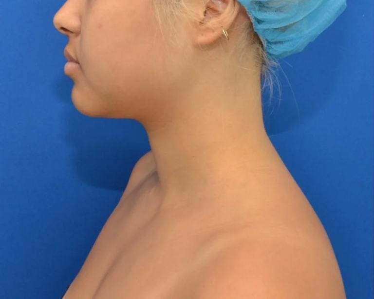 Before Image: Precision Sculpt® — chin, neck, and jawline - left-side
